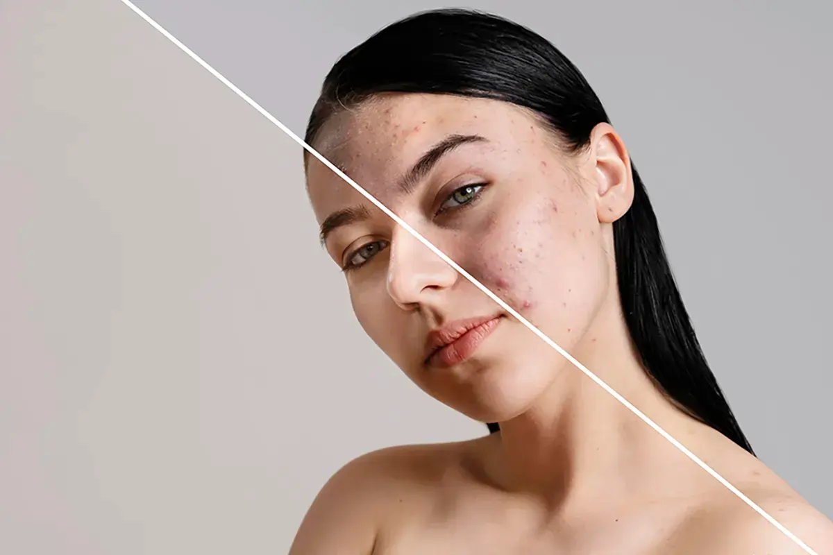 راهنمای علمی تزریق فیلر برای جای جوش